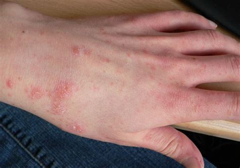 12 Perfect And Effective Home Remedies For Scabies Journal Red