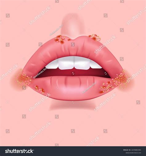 Rash On Lips Herpes Pimples Ulcers Stock Vector Royalty Free