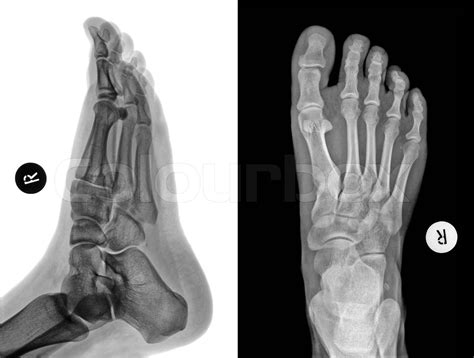 Detail Of An X Ray Of A Foot Stock Image Colourbox