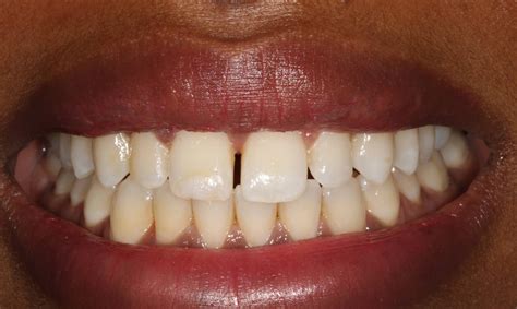 Gallery - Composite Resins Bonding - Uptown Guelph Dental
