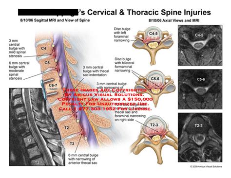 AMICUS Illustration Of Amicus Injury Cervical Thoracic Spine Sagittal Axial MRI Bulge Disc