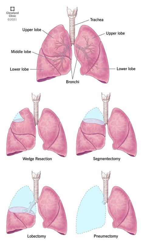 Lung Resection Surgery Procedure Details And Recovery 2022