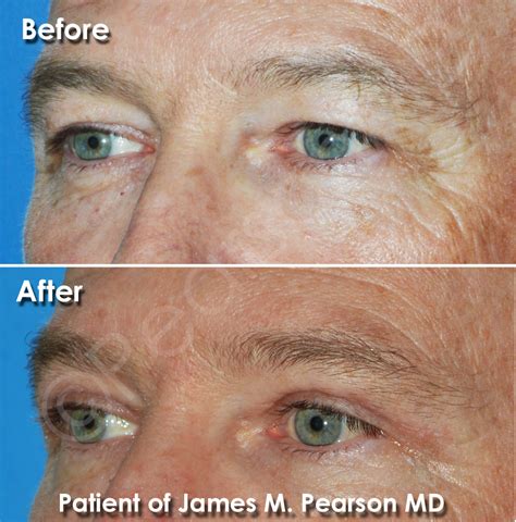 Blepharoplasty Upper Eyelid Lift Photos Dr James Pearson Facial