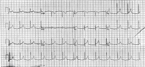 1600 x 1188 png 2050kb. South Wales Cardiac Network | WPCCS ECG Quiz Answers