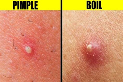 Boil Vs Cyst The True Differences Between The Two