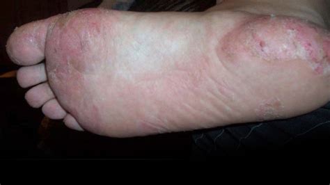 Dyshidrotic Eczema Feet