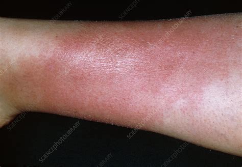 Cellulitis On A Womans Leg Stock Image M1300484 Science Photo