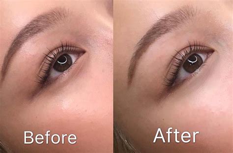 Permanent Under Eye Concealer Tattoo Is A Cosmetic Procedure That