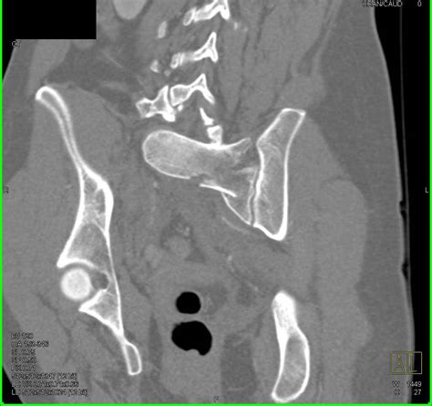 Complex Sacral Fracture with Hematoma - Trauma Case ...