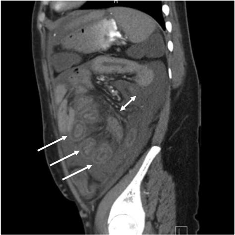 Sagittal View Of Ct Abdomen Showing Target Sign Single Arrow With