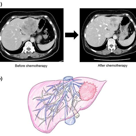 A Contrast Enhanced Ct Findings Before And After Chemotheraphy B