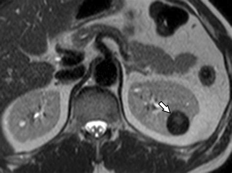 Differentiation Of Solid Renal Tumors With Multiparametric Mr Imaging