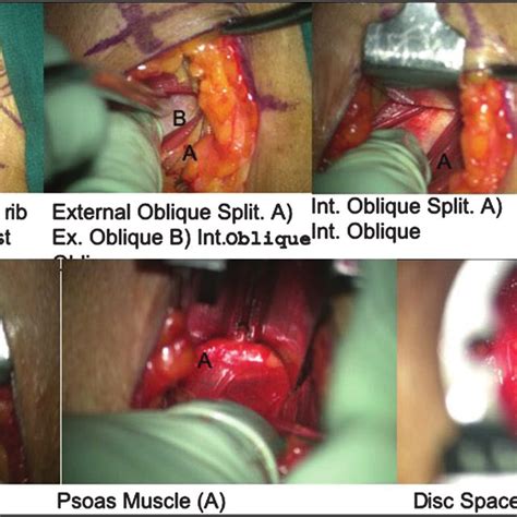 Intraoperative Surgical Approach Steps Download Scientific Diagram