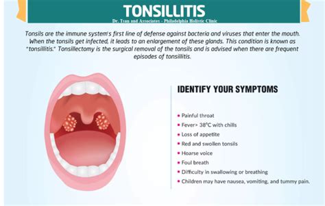 Treatment Of Tonsillitis Philadelphia Holistic Clinic Dr Tsan Associates