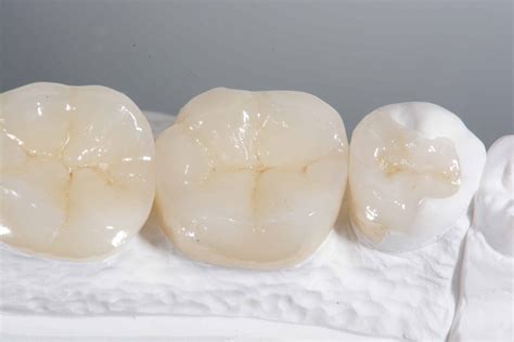 Posterior Ceramic Restorations Stevenson Dental Solutions