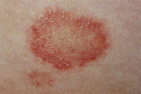 Common Skin Diseases My Spots And Me