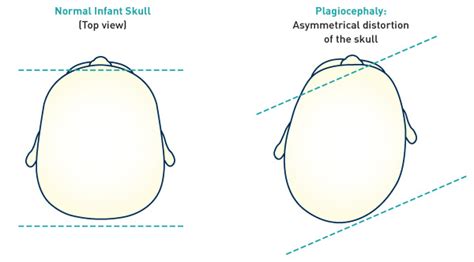 Plagiocephaly Asymmetrical Distortion Of The Skull Cranial Center