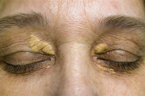 Yellow Eyelids Xanthelasma High Resolution Pictures And
