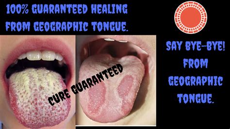 Burning Tongue Treatment Geographic Tongue Cure 100 Guaranteed