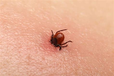 Tick Bites Symptoms Treatments And Prevention