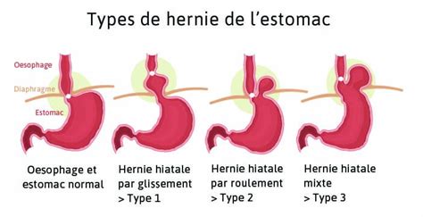 Types De Hernie De L Estomac Reflux Gastro Oesophagien Reflux Gastrique