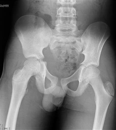 Male Femur X Ray My Xxx Hot Girl