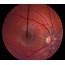 Unilateral Optic Nerve Hypoplasia In A Patient Desiring Surgical 