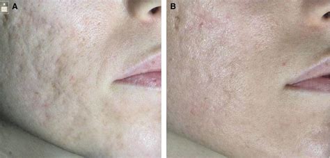 A Acne Scars Boxcar And Icepick Before Treatment In A 41 Year Old