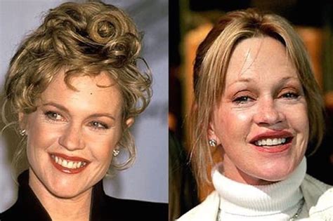 Worst Cases Of Celebrity Plastic Surgery Gone Wrong
