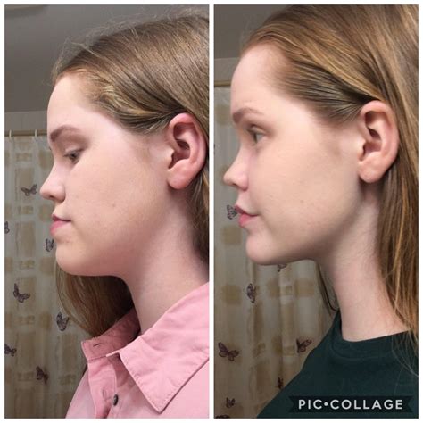 Bottom Jaw Surgery Before And After Girlycop