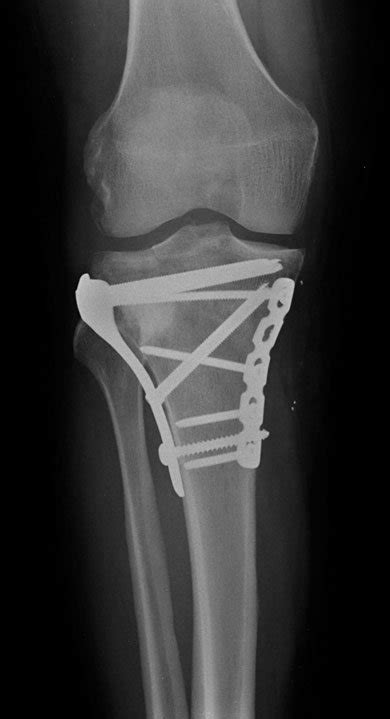 I Have a 45-Year-Old Female With a Bicondylar Tibial ...