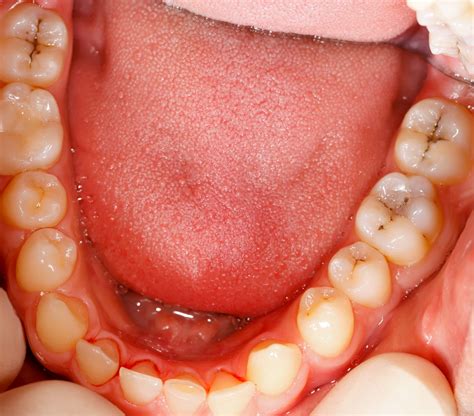 Cavities In Back Teeth