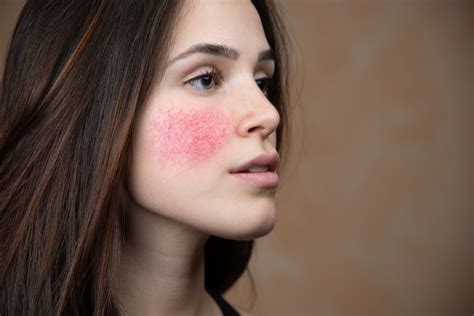 Rosacea Identifying Symptoms And Managing Flare Ups Face Fresh