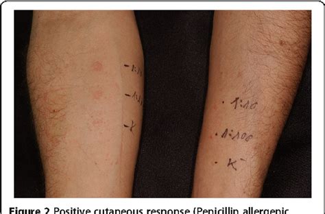 Figure 2 From Amoxicillin Rash In Patients With Infectious