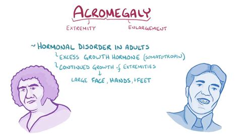 acromegaly osmosis video library