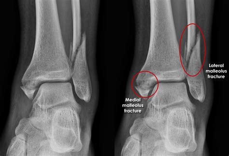 Trauma X Ray Lower Limb Gallery 2 Ankle Trimalleolar Fracture