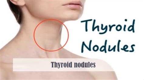 A Brief Description About The Thyroid Nodules Symptoms And Its Treatment