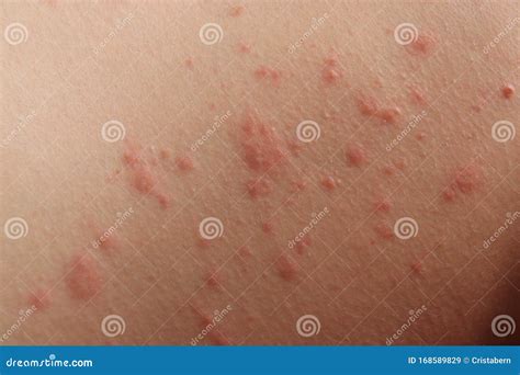 Irritation And Rashes On Caucasian Skin Stock Image Image Of Reaction