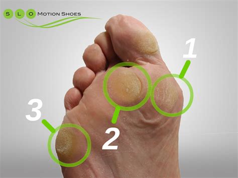 The Anatomy Of A Callus Slo Motion Shoesslo Motion Shoes