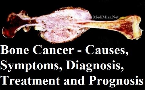 Bone Cancer Causes Symptoms Diagnosis Treatment And Prognosis