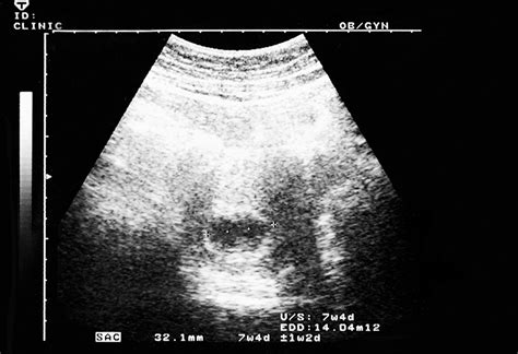 7 Weeks Pregnant Ultrasound Procedure Abnormalities And More