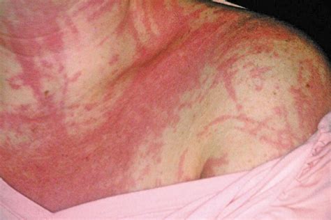 10 Serious Conditions That Rashes And Hives Can Indicate Page 5