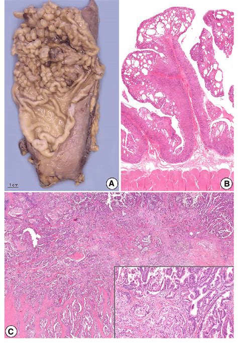 Fundic Gland Polyposis Ab And Tubularpapillary Adenocarcinoma
