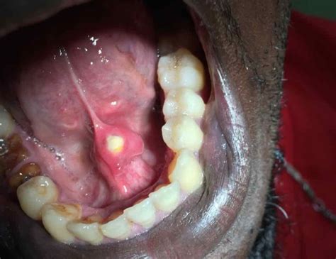 Image Of The Week A Hard Lesion Near The Frenulum Of The Tongue