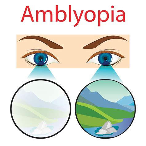 Strabismus And Amblyopia Azar Eye Clinic
