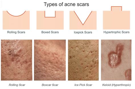 What Really Happens When You Get Laser Procedure For Acne Scarring