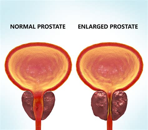 Benign Prostatic Hyperplasia Enlarged Prostate Mitec