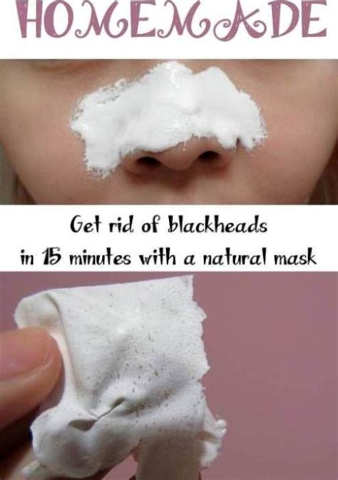 How To Get Rid Of Blackheads In 15 Minutes Active Home Remedies