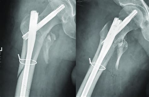 Percutaneous Cerclage Using Can Be Performed To Maintain A Reduction In