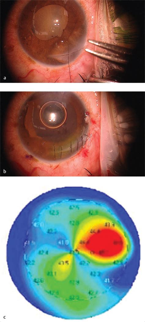 25 Anterior Segment Repair And Reconstruction In Traumatic Cases Ento Key